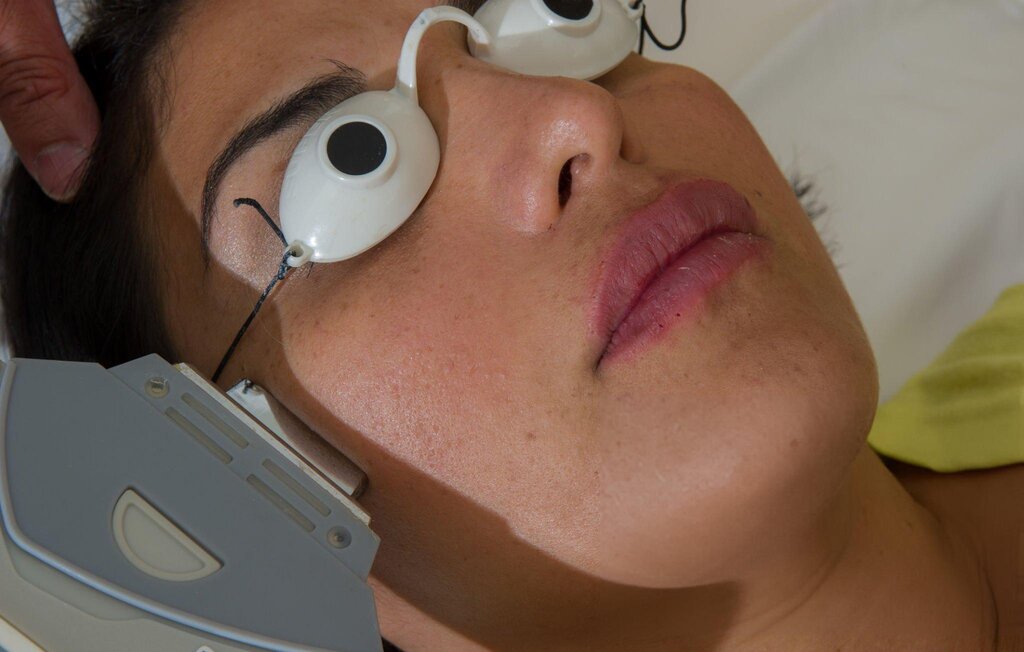 IPL photofacial