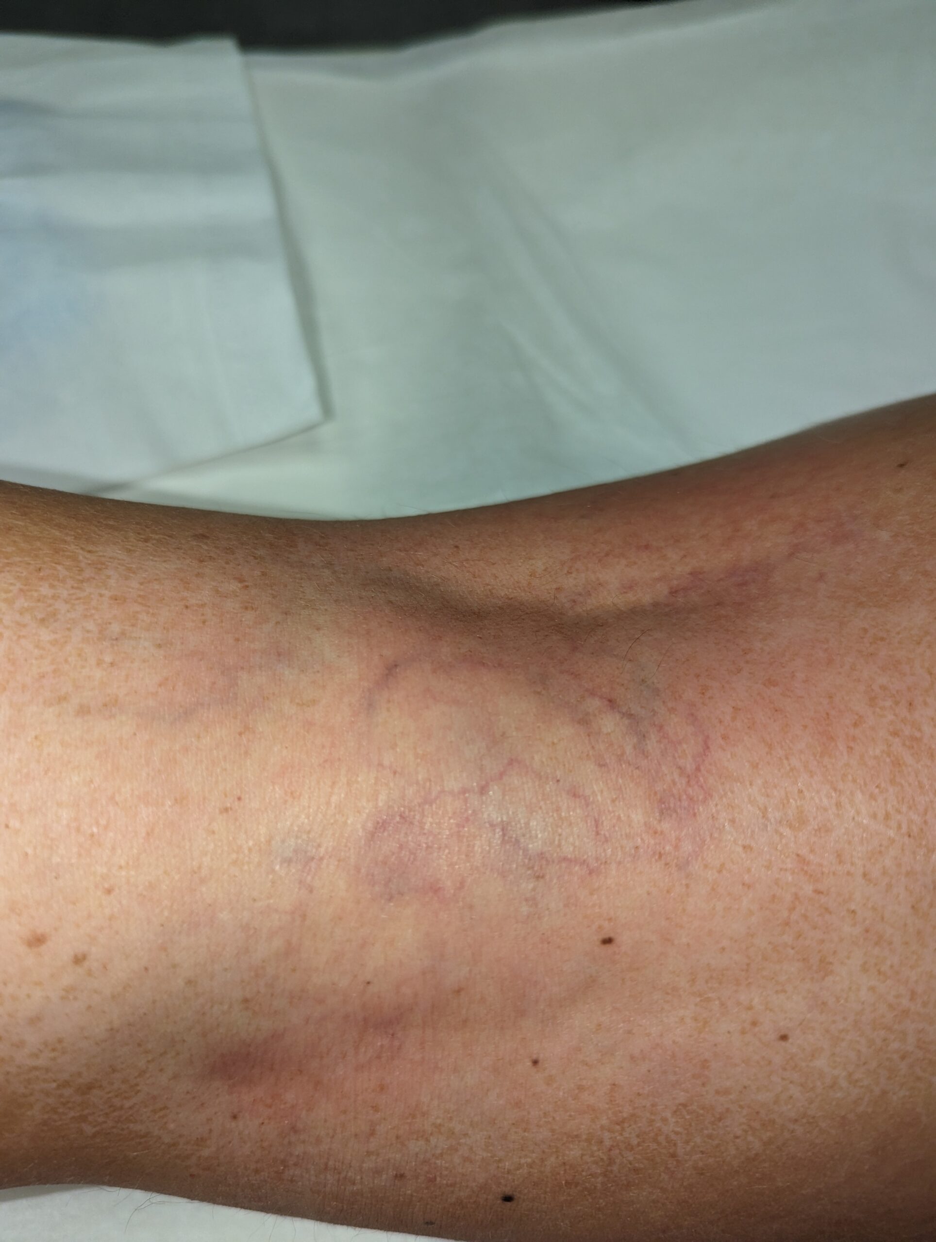 VEINS AFTER FEB LUISE