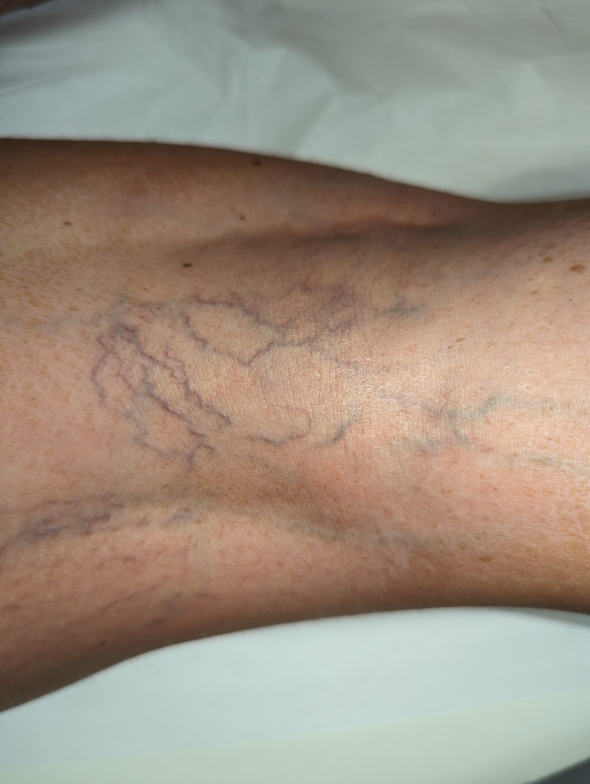 VEINS BEFORE FEB LUISE