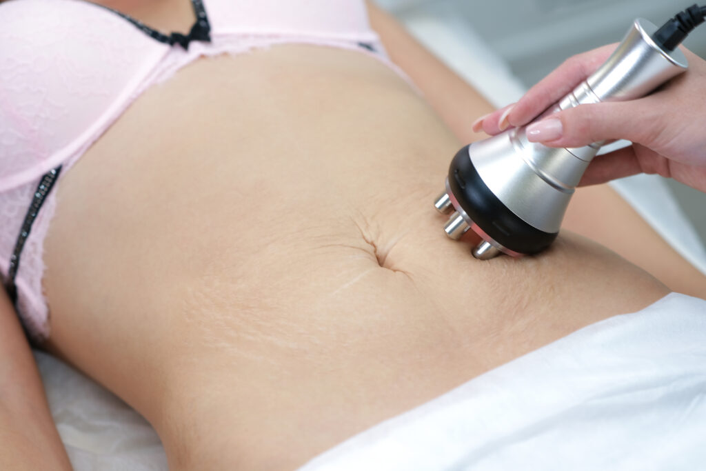 Stretch,Marks,On,The,Skin,After,Childbirth,And,Weight,Loss