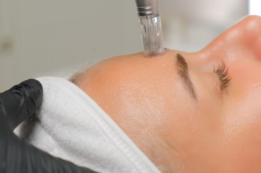 Microneedle,Rf,Lifting,Procedure ,A,Cosmetologist,Performs,A,Facial,Rejuvenation