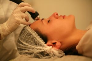 Photofacial Treatment